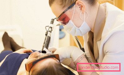 laser arr fjerning laser arr fjerning