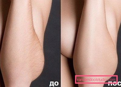 kvinnelig underarm før og etter legemidlet kvinnelig underarm før og etter legemidlet