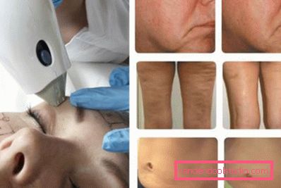 effekt fra maskinvare kosmetologi effekt fra maskinvare kosmetologi