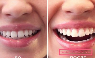 Whitening resultat før og etter Whitening resultat før og etter